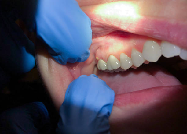 Best Emergency Treatment for Dental Infections or Abscesses in Bonners Ferry, ID