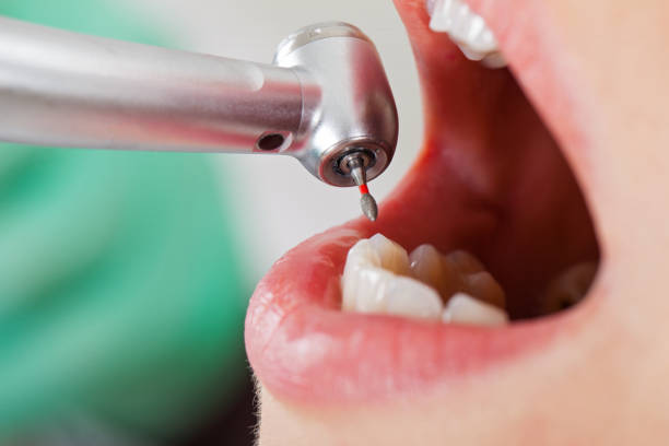 Best Emergency Tooth Extraction in Bonners Ferry, ID